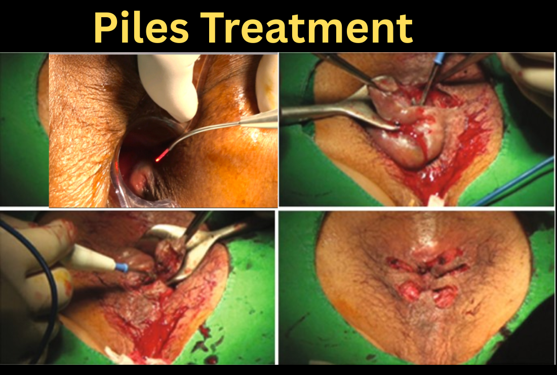 piles treatment