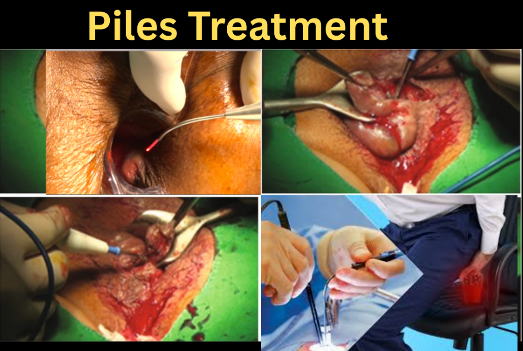 piles treatment