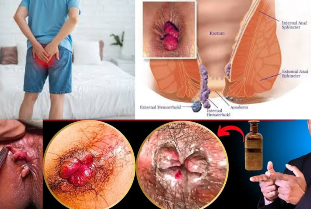 Permanent Piles Treatment Without Surgery