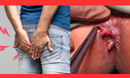 Fistula Treatment